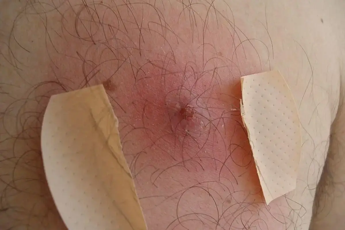 Bisul sepsis